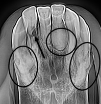 hypercementosis