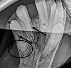 hypercementosis